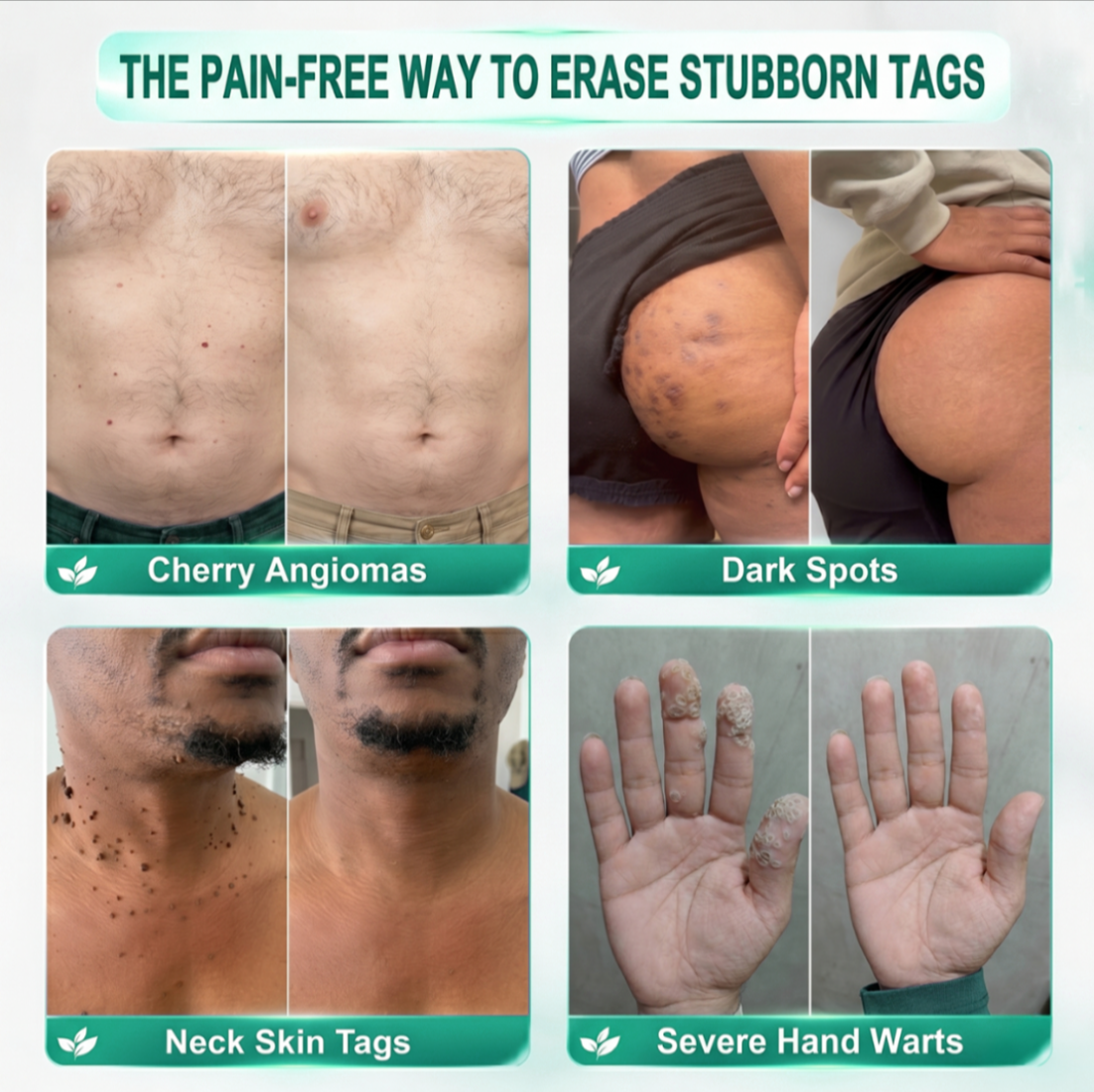 🌟 𝐎𝐟𝐟𝐢𝐜𝐢𝐚𝐥 𝐒𝐭𝐨𝐫𝐞 | GFOUK®  🍃𝐁𝐨𝐭𝐚𝐧𝐢𝐜𝐚𝐥 𝐌𝐢𝐜𝐫𝐨𝐧𝐞𝐞𝐝𝐥𝐞 𝐇𝐲𝐝𝐫𝐨𝐜𝐨𝐥𝐥𝐨𝐢𝐝 𝐏𝐚𝐭𝐜𝐡 (𝐅𝐨𝐫 𝐒𝐤𝐢𝐧 𝐓𝐚𝐠𝐬, 𝐒𝐦𝐚𝐥𝐥 𝐒𝐤𝐢𝐧 𝐆𝐫𝐨𝐰𝐭𝐡𝐬, 𝐖𝐚𝐫𝐭𝐬, 𝐌𝐨𝐥𝐞𝐬, 𝐀𝐠𝐞 𝐒𝐩𝐨𝐭𝐬 & 𝐏𝐢𝐠𝐦𝐞𝐧𝐭𝐚𝐭𝐢𝐨𝐧 𝐂𝐨𝐧𝐜𝐞𝐫𝐧𝐬)
